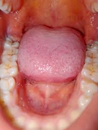 Dentist recommendations for pregnancy tooth removal