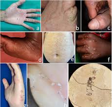 Image result for scabies on genitals