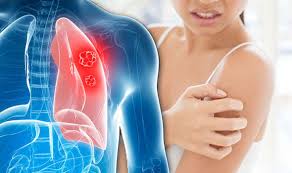 Lung cancer—not breast or uterine or ovarian cancer—claims more women's lives every year than any other type of cancer. Lung Cancer Symptoms Tumour Signs Include Skin Lumps And Bumps Risk Revealed Express Co Uk