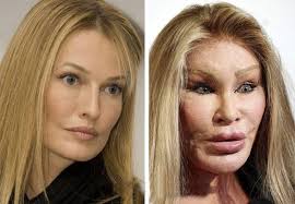 Who underwent too much cosmetic surgery in Hollywood?
