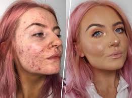 Pour venir à bout de l'acné, aussi bien à l'adolescence qu'à l'âge adulte, il est important d'agir localement et de nettoyer. Abbie Bull Atteinte D Acne Kystique Elle Demontre La Magie Du Fond De Teint Huda Beauty