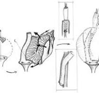 Enterocystoplasty (ECP) combined with abdominal continent ...