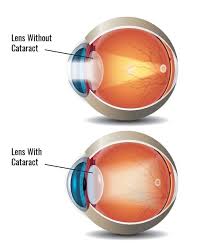 Image result for Cataract Extraction