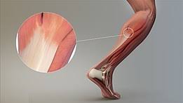 Proximate ligaments pass over at least two joints, close to their capsules. Tendon Wikipedia