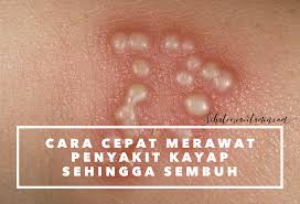 Umumnya masyarakat mengenal dua golongan kakap, yaitu kakap merah dan kakap putih. Cara Rawat Kayap Archives Pengedar Shaklee Ipoh Perak