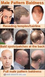 How Does Male Pattern Baldness Develop Only Skull Expansion Can Explain How The Classic Signs Of Balding Male Pattern Baldness Hair Loss Men Pattern Baldness