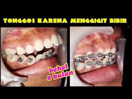 Posisi gigi tonggos atau gigi atas lebih maju dibanding gigi bawah. 8 Bulan Perawatan Behel Gigi Tonggos Akibat Kebiasaan Buruk Menggigit Bibir Dokter Gigi Jogja Youtube