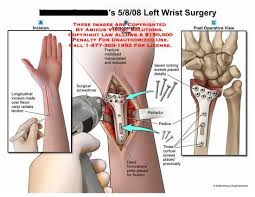Left Wrist Surgery Broken Wrist Hand Surgery Surgery