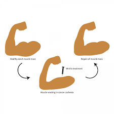 Aug 10, 2020 · lipodystrophy is a disorder that affects how a person's body accumulates and stores fat. Cancer Cachexia Help Against Muscle Loss Healthcare In Europe Com