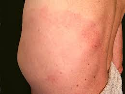 Jan 15, 2021 · untreated lyme disease can produce a wide range of symptoms, depending on the stage of infection. Maladie De Lyme Symptomes Et Traitement Consultez Sur Livi
