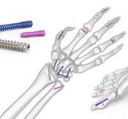 Acutrak 2 Headless Compression Screw System | Acumed