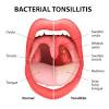 Impetigo, piodermite, stafilodermii, pneumonie stafilococică. Https Encrypted Tbn0 Gstatic Com Images Q Tbn And9gcqcxy6fao3jukbbjsyvmkfuszebtlcf99gd1gatpzjqwsxzwirf Usqp Cau