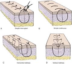 Suturing is a term used to describe the closing of a wound, artery, or part of an organ using a specific needle and thread. Best Mattresses Of 2020 Updated 2020 Reviews Buried Vertical Mattress Suture