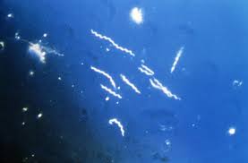 News Recent Study Suggests That Lyme Disease Can Be Sexually Transmitted Lymedisease Org
