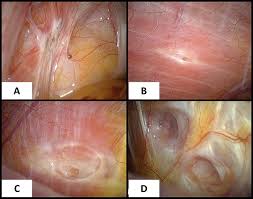 A pilot systematic review of the effects of aromatase inhibitors on pain associated with endometriosis. Delay In Diagnosis Of Endometriosis A Case Report Of Catamenial Pneumothorax British Journal Of General Practice