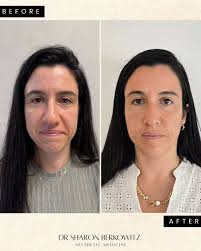 ☀️SUMMER IS COMING☀️ #בוטוקס #בוטוקס💉 #רפואהאסתטית #חומצההיאלרונית #botox  #hyperhidrosis