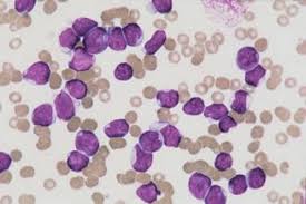 These depend on the type of blood cancer a patient is experiencing. Pediatric Acute Lymphoblastic Leukemia Practice Essentials Background Pathophysiology