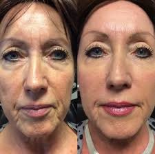 Ultimate Guide to Lip Fillers in Phoenix, AZ