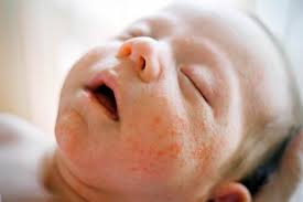 Image result for Atopic eczema atopic dermatitis
