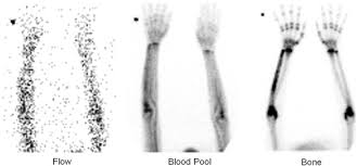 Image result for Osteomyelitis Bone Scan