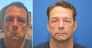 Facial paralysis surgery and treatment