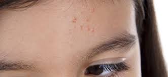 Causas Del Acne En La Infancia