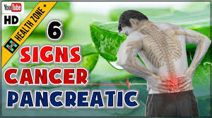 Jaundice, pale & smelly stools, upper abdominal pain. 6 Warning Signs And Symptoms Of Pancreatic Cancer No 5 Is Shocking Youtube