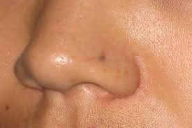 How To Get Rid Of Nose Piercing Scar Nose Nospiercingscar Nosepiercing Nose Piercing Scar Keloid Remove Dark Spots
