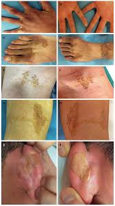 Recurrence is rare, with only a few cases reported; Pleomorphic Cutaneous Xanthomas Disclosing Homozygous Familial Hypercholesterolemia