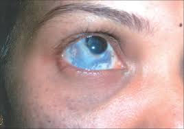 Image result for nevus sclerae