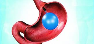 ما هو بالون المعدة موضوع