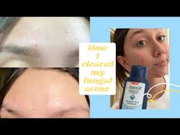 Last updated on april 28, 2020. Nizoral A D Anti Dandruff Shampoo Coupon 09 2021