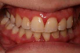 Gum Disease Pictures What Do Healthy Gums Look Like