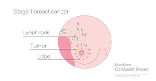 How does the doctor know i have breast cancer? Breast Cancer Recurrence Test Oncostem Blog