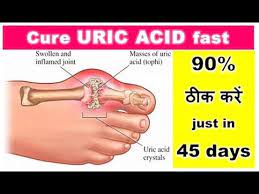 Uric acid is a heterocyclic compound of carbon, nitrogen, oxygen, and hydrogen with the formula c5h4n4o3. Uric Acid 90 à¤  à¤• à¤•à¤° Just In 45 Days Cure Uric Acid Fast Relieve Your Body Pain Dr Shalini Youtube