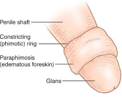 Image result for paraphimosis