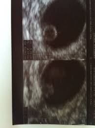 Lässt sich darauf ein embryo in einer intakten fruchtblase erkennen und eventuell schon ein herzschlag nachweisen (frühestens ab. 6 6 Keine Herztone Zu Kleiner Embryo Schwangerschaftsgruppe Babycenter