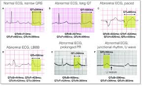 Examples Of Qt Measurement And Correction Qtc Ecg Strips
