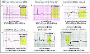 examples of qt measurement and correction qtc ecg strips