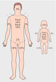 Complete Rule Of 9 For Burn Rule Of Nines Pediatric Burn