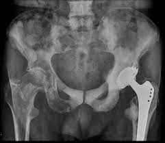 But hearing the words can still be scary. Osteoblastic Metastases Prostate Carcinoma Radiology Case Radiopaedia Org