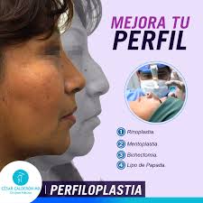 LUCE UN PERFIL MAS ESTILIZADO Y ARMÓNICO La combinación de varias cirugías  faciales como la #rinoplastia, #mentoplastia, #bichectomia y/o lipo de  papada se denomina #perfiloplastia y mejora maravillosamente la belleza  facial, rejuveneciendola