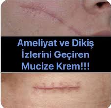 En Iyi Yara Izi Krem Ve Yara Izini Geciren Krem Onerisi Krem Saglik Urunleri Guzellik