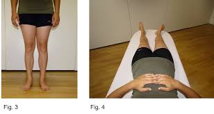 Image result for Femoral Retroversion