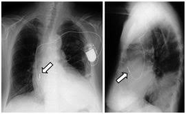 Cardiac pacemaker defibrillator icd crt difference pacemakers defibrillators devices resynchronization between medicine hospital implantable note anesthesia. Kjr Korean Journal Of Radiology