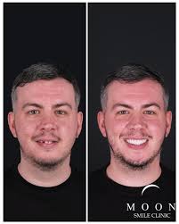 🦷➡️ Swipe to See This Stunning Transformation! Ready for your own smile  makeover? Let's chat! 📞+905303130520 📞+905454995159 📞+905324995159  #dentaloffice #dentaltok #implant #implantdentures #zircônias  #zirconiacrown #emax #emaxpress #emaxveneers ...