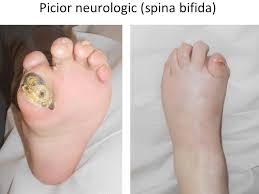 Bunica spunea despre supa de pui sau de gaina ca este folosim preferabil gaina de casa sau cocos. Metatarsalgii Boala Morton Durerea Plantara