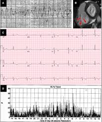 Find cardiac arrest latest news, videos & pictures on cardiac arrest and see latest updates, news, information from ndtv.com. Role Of Bilateral Sympathectomy In The Treatment Of Refractory Ventricular Arrhythmias In Arrhythmogenic Right Ventricular Dysplasia Cardiomyopathy Circulation Arrhythmia And Electrophysiology