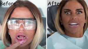 Katie showed what her teeth really look after being filed down to make room for veneers. Katie Price Teeth With Without Veneers