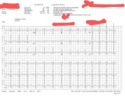 Image result for Right Bundle Branch Block